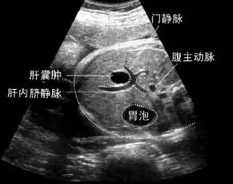 肝脏|体检发现“肝囊肿”怎么办？会不会变癌？要不要吃药？医生给你说清楚