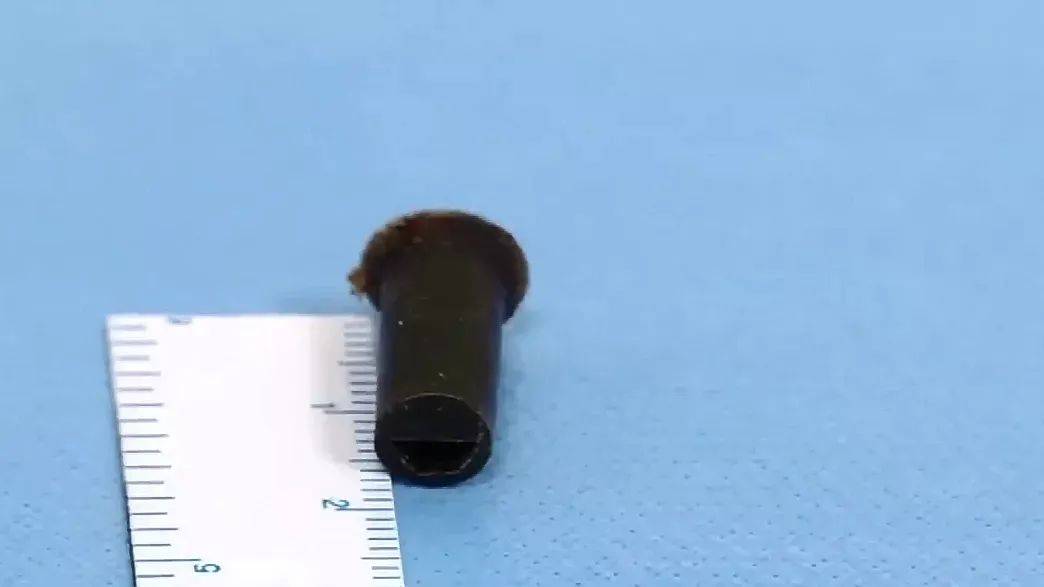 地方|帅小伙6岁时吞哨子怕被骂瞒了20年！如今咳得不行了只能做手术