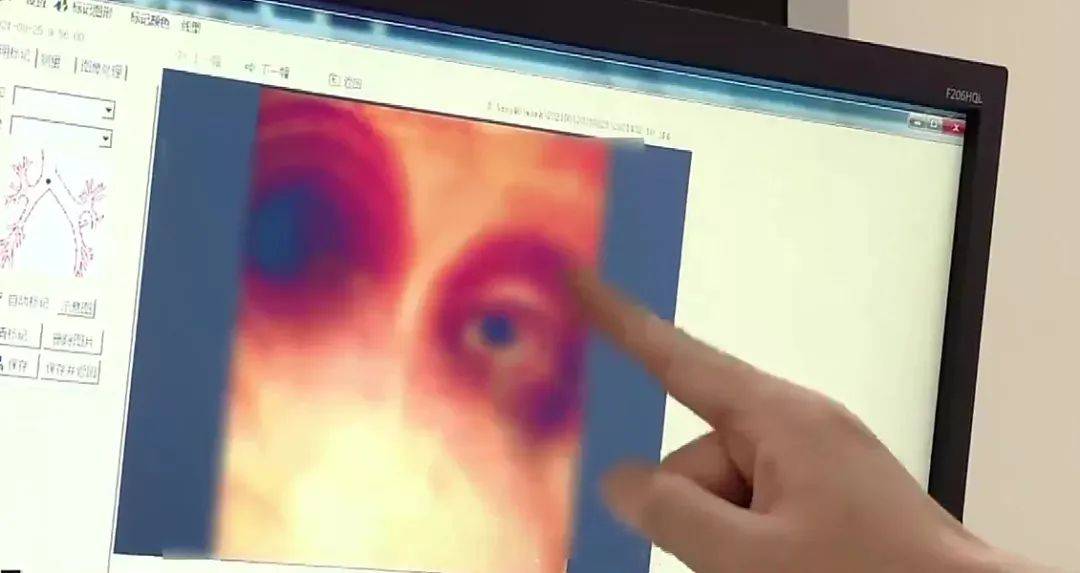 地方|帅小伙6岁时吞哨子怕被骂瞒了20年！如今咳得不行了只能做手术