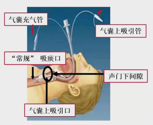 气管造瘘口图片