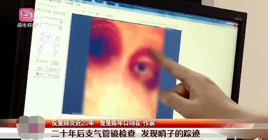 发声|冲上热搜！男子6岁吞哨子怕被骂瞒了20年，多年来反复肺炎?
