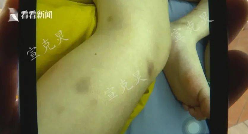 腿上有十几条棍子抽的红印整条腿都是肿的洪女士发现儿子下身上的伤