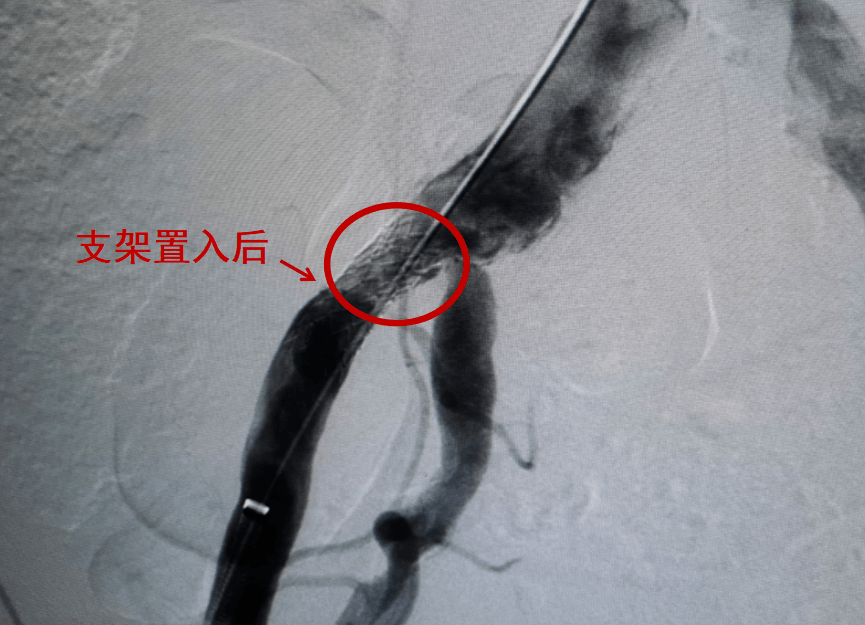 首例寿阳人民医院成功开展骼血管支架置入手术为患者打通活血隧道