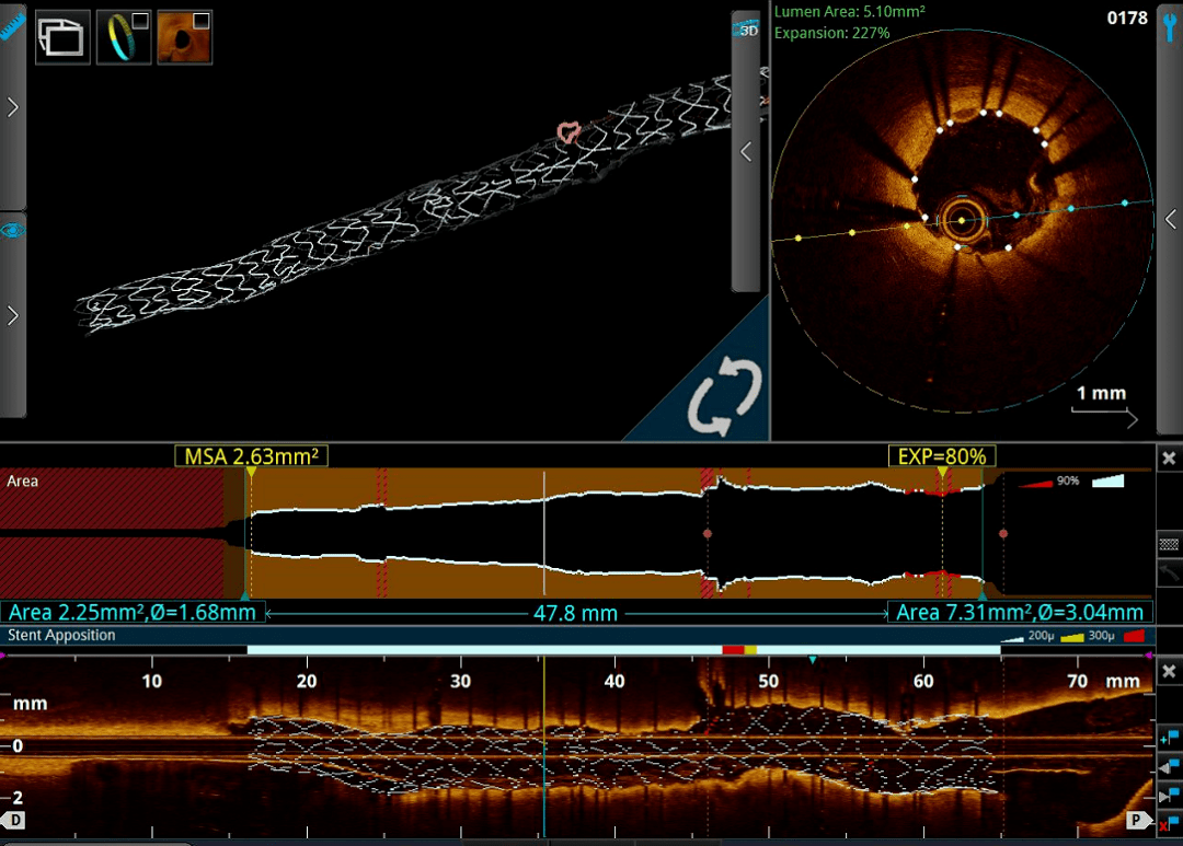 技术突破市一院成功开展oct指导的冠脉介入治疗
