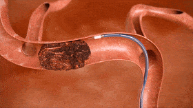 三年来首次收购雅培将这除栓神器纳入旗下