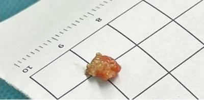 呼吸与危重症医学科主任胡轶介绍,支气管结石相对比较少见,多数是淋巴