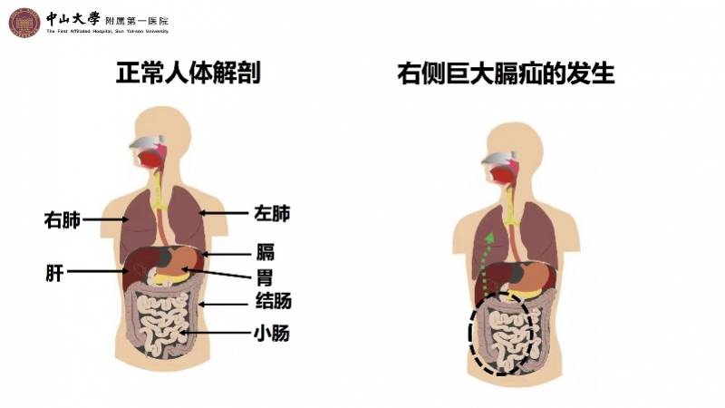 手术|过量运动后肠道“搬家”，巨大膈疝致小肠、阑尾挤瘪右肺