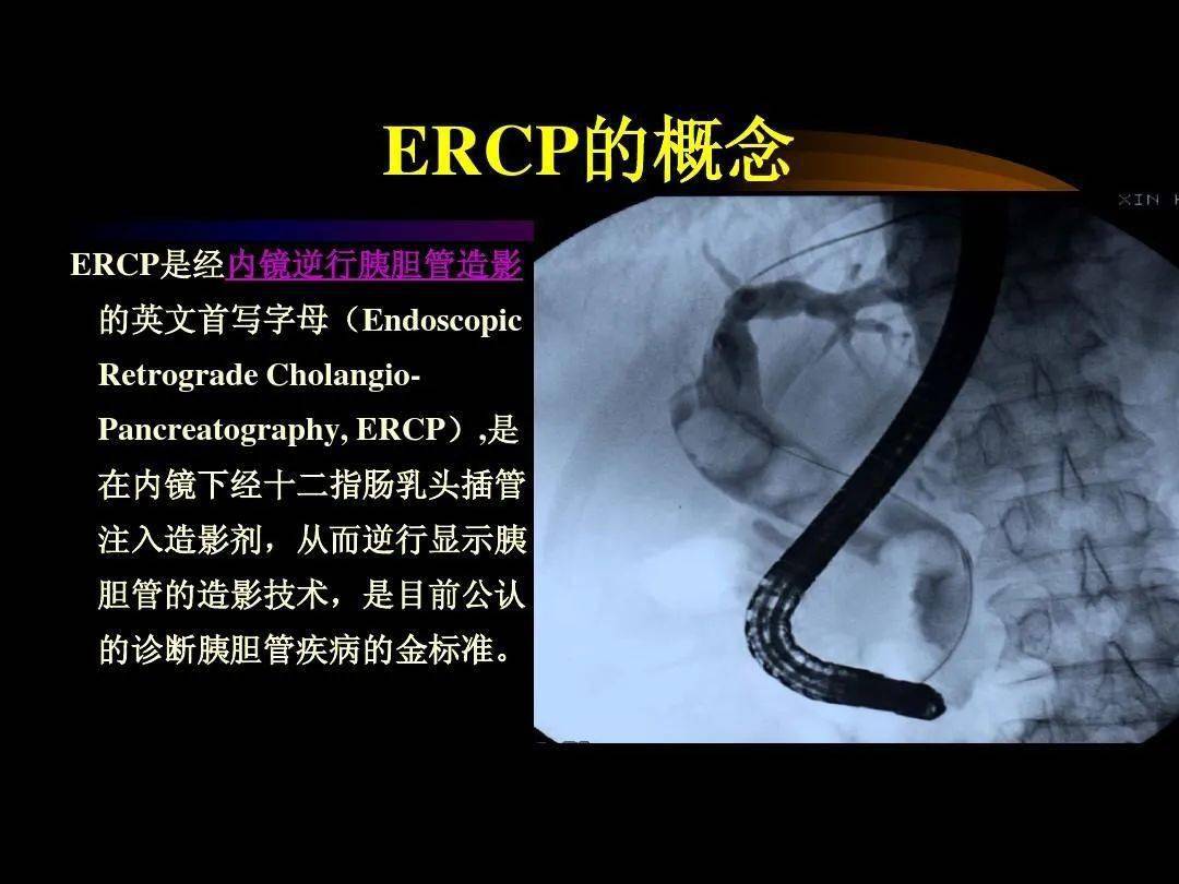 我娃儿童胆囊结石 快切快切 No 孩子胆囊结石可不能一切了之 治疗