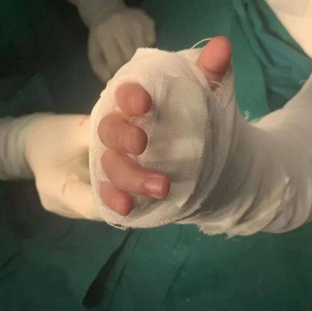 一名外地2岁多幼儿,因车祸导致右手腕关节离断,被紧急送到北京积水潭