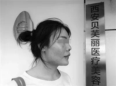 女子在贝芙丽美容做隆鼻手术 鼻头萎缩成八级伤