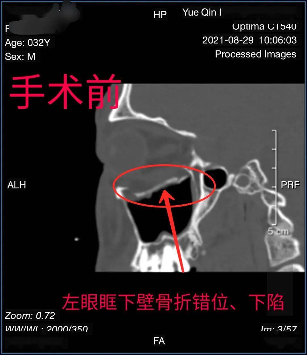 患者張某,因外傷導致左眼眶下壁骨折,ct提示左眼眶下壁骨折錯位,下陷