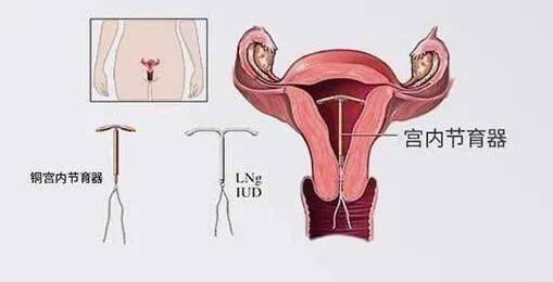 女性上环过程子宫图片