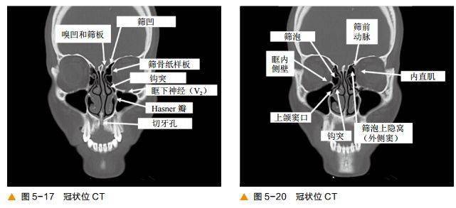 超清圖解鼻竇及顱底ct解剖