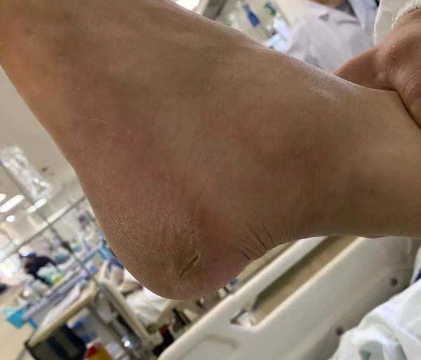 黄先生|杭州男子突发全身抽搐，被送进ICU！医生一看脚后跟····
