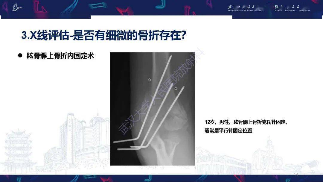 兒童肘關節外傷x線診斷_解剖圖