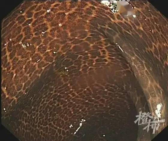 泻药|阿姨吃三年酵素肠子表面像蛇皮！医生提醒→