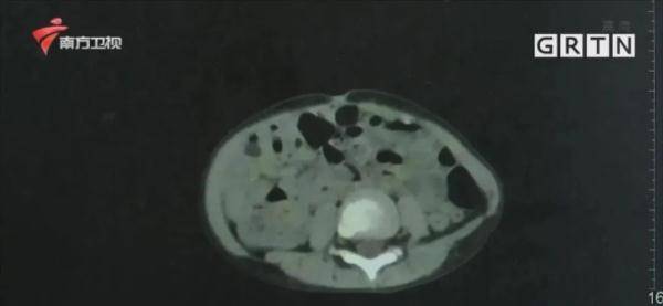 饮食|2岁男童体内竟然有3颗肾结石！