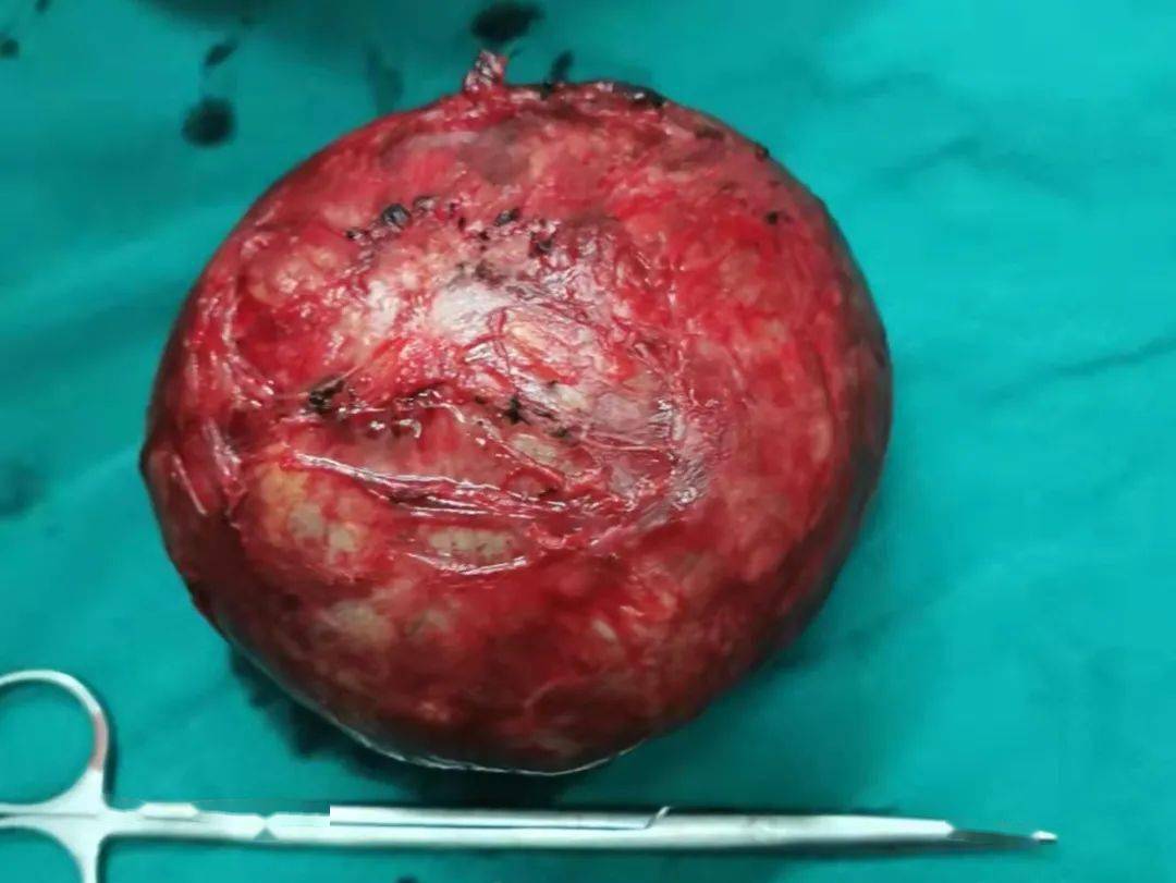重达5斤慈林医院泌尿外科成功切除一例腹膜后巨大肿瘤