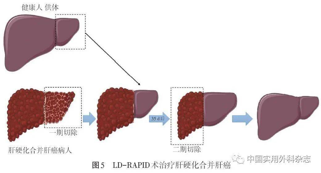讲座辅助肝移植技术创新与展望