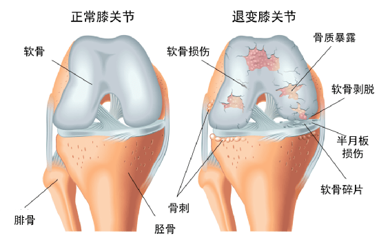 跑步跑出关节积液可怕吗 有什么后果 如何解决 软骨