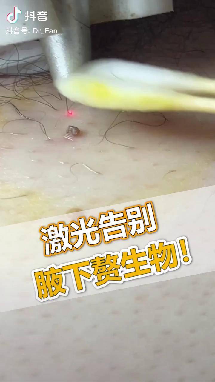 腋下长小球球这么办樊哥撩皮肤皮赘知识创作人