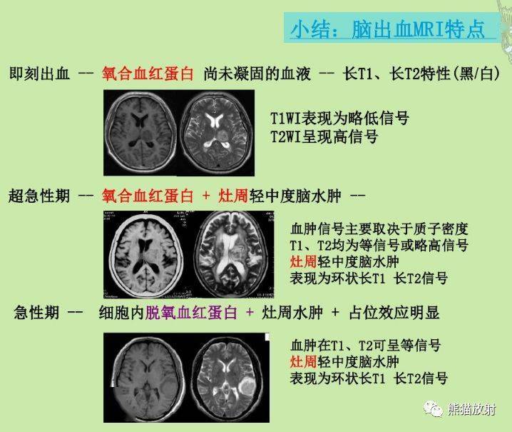 脑出血mri信号演变丨包懂包会