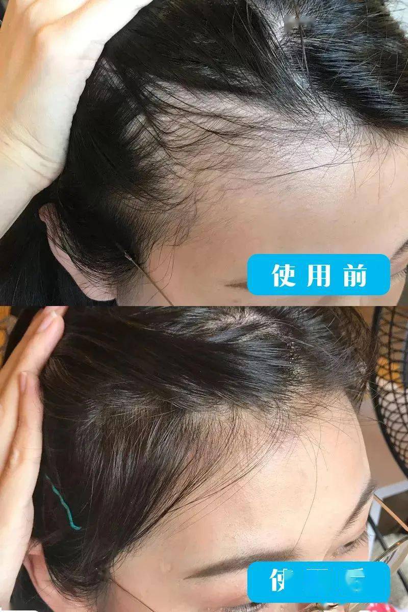 汪女士|白发越长越多？原来是这里出了毛病！坚持一招，养一头乌黑墨发！