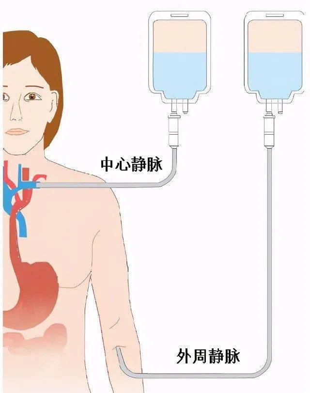 全身的所有静脉通路都是可以留置导管的,对于需要长时间接受肠外营养