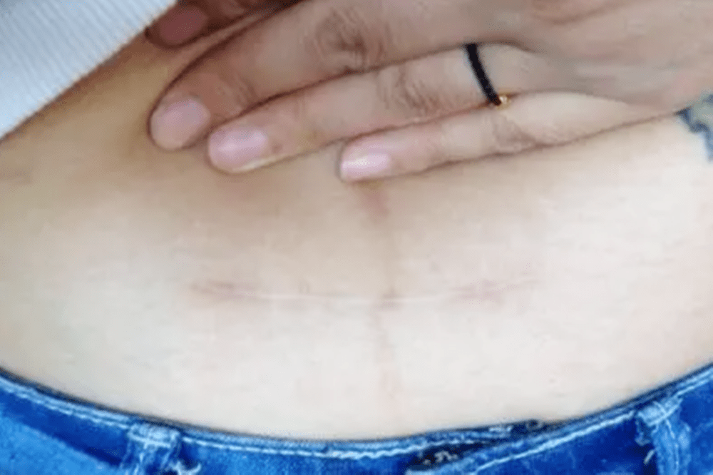 竖剖腹产后的疤痕图片图片