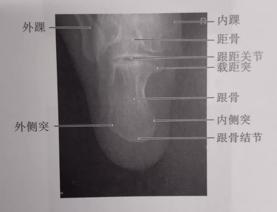 67跟骨轴位中心线向头侧倾斜3545且听我慢慢分析
