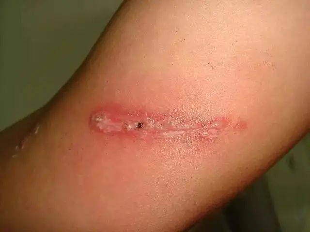 这种虫飞到脸上别用手拍!好多十堰人"毁容"!_皮肤