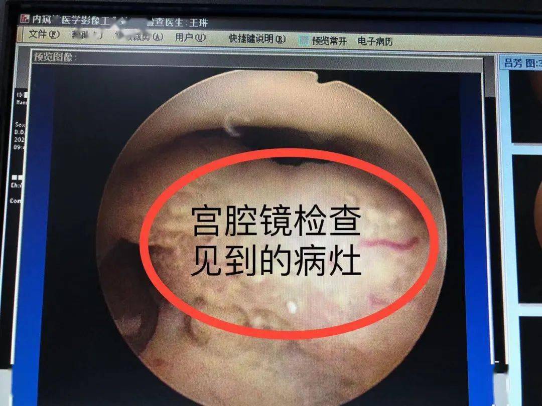 术精岐黄丨一个电话救了一名子宫内膜癌患者