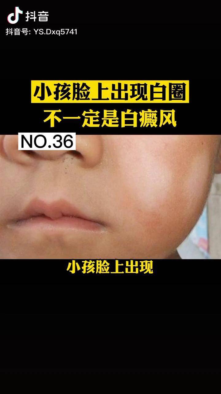 很多小孩脸上有白圈,可能不是白癜风,处理起来很简单白色康疹 小孩