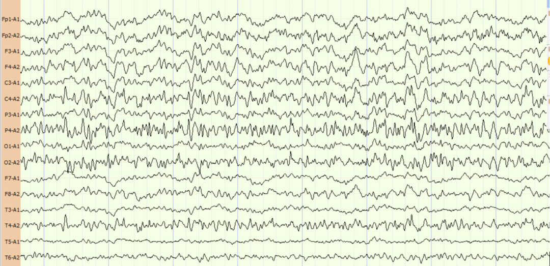 此时的王大伯,格拉斯哥昏迷评分(gcs)1t3,属中度昏迷状态,生命体征也