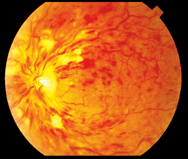 vein occlusion,rvo)是仅次于糖尿病性视网膜病变的常见视网膜血管
