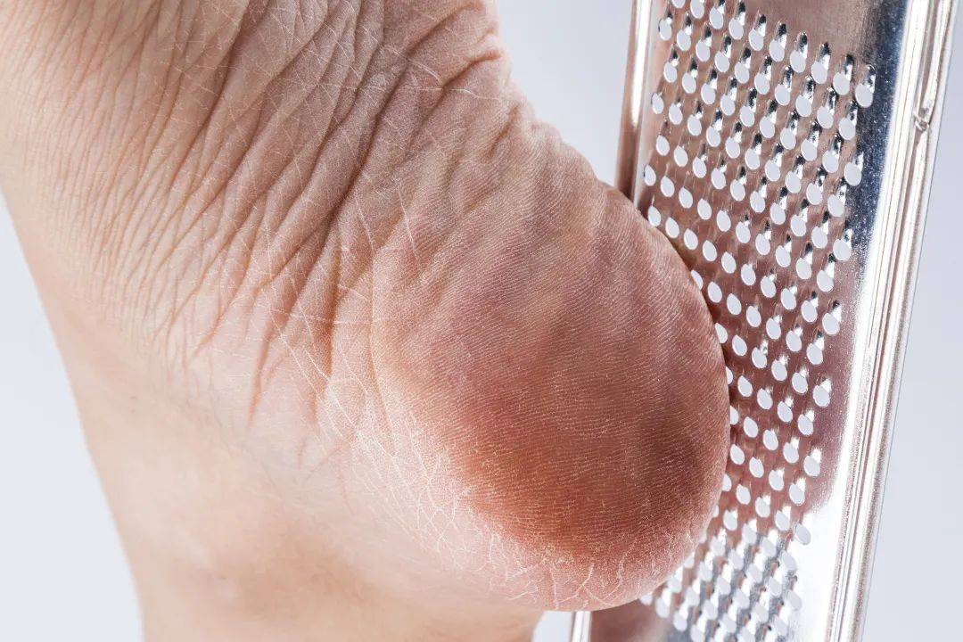 高跟鞋|“鸡眼”偏爱这4种人，你中招了吗？