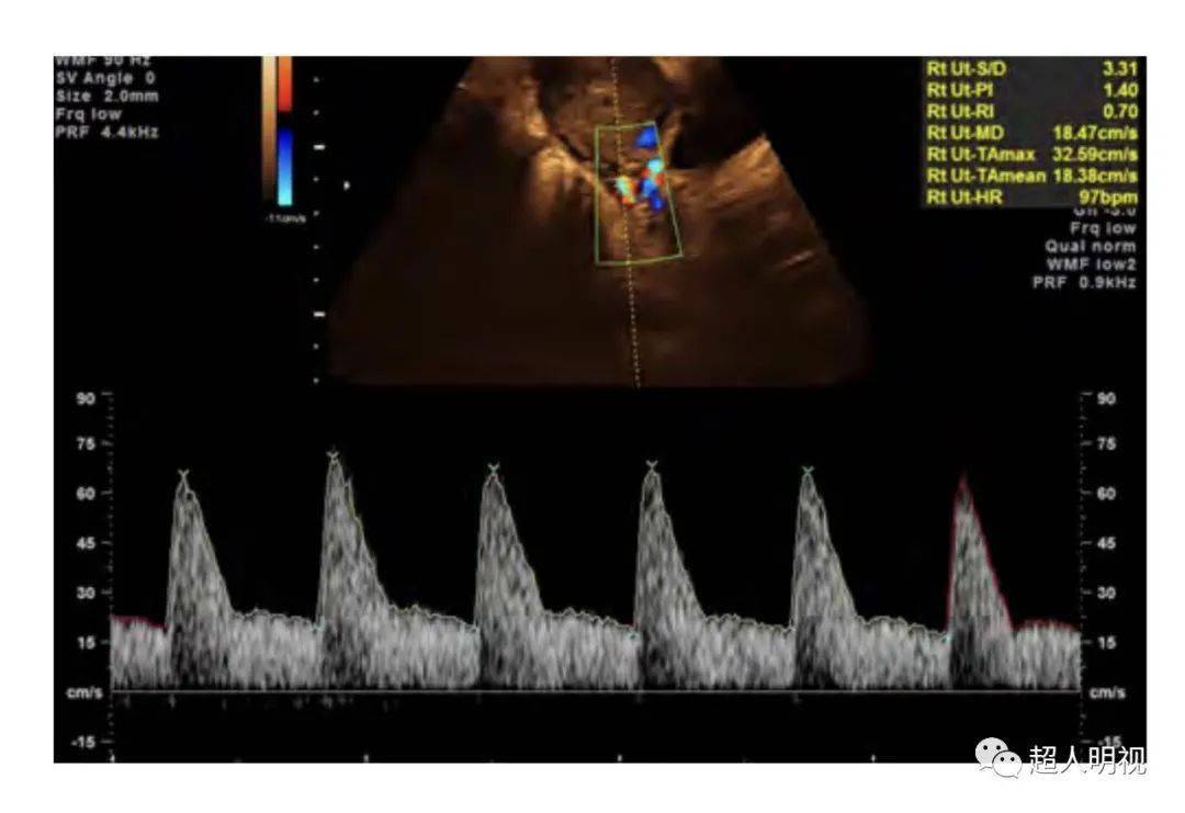 多普勒彩超图片怎么看图片