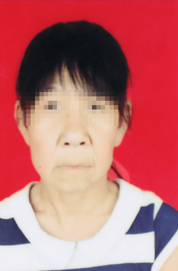 老人|14岁少女皮肤下垂似老人，已在上海一医院做第一期整形手术