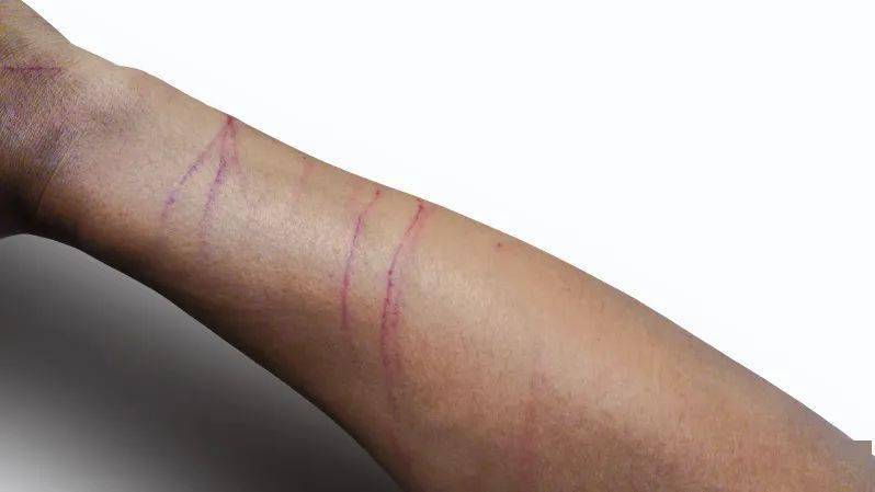 死亡率几乎100%的狂犬病如何应对?_伤口