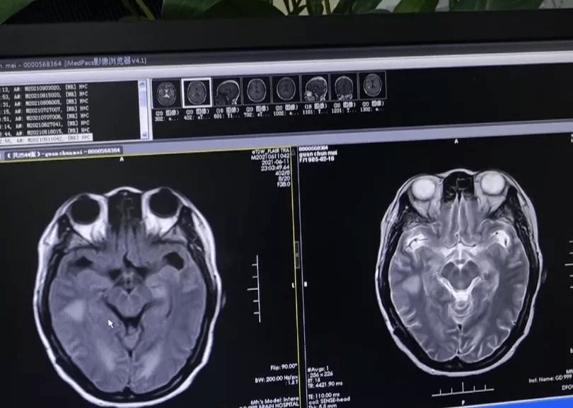 粪便|女子帮丈夫杀鸡后失去意识，竟是患上了致死率40%的重疾…...