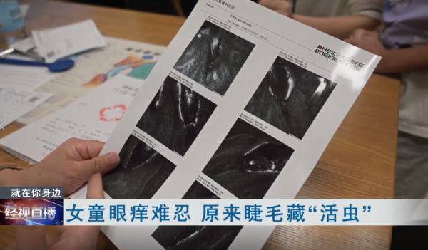 家长奇痒难耐，10岁女孩拔光眼睫毛，元凶竟是它！医生紧急提醒