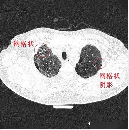 间质性肺炎的典型图谱,最全解析!