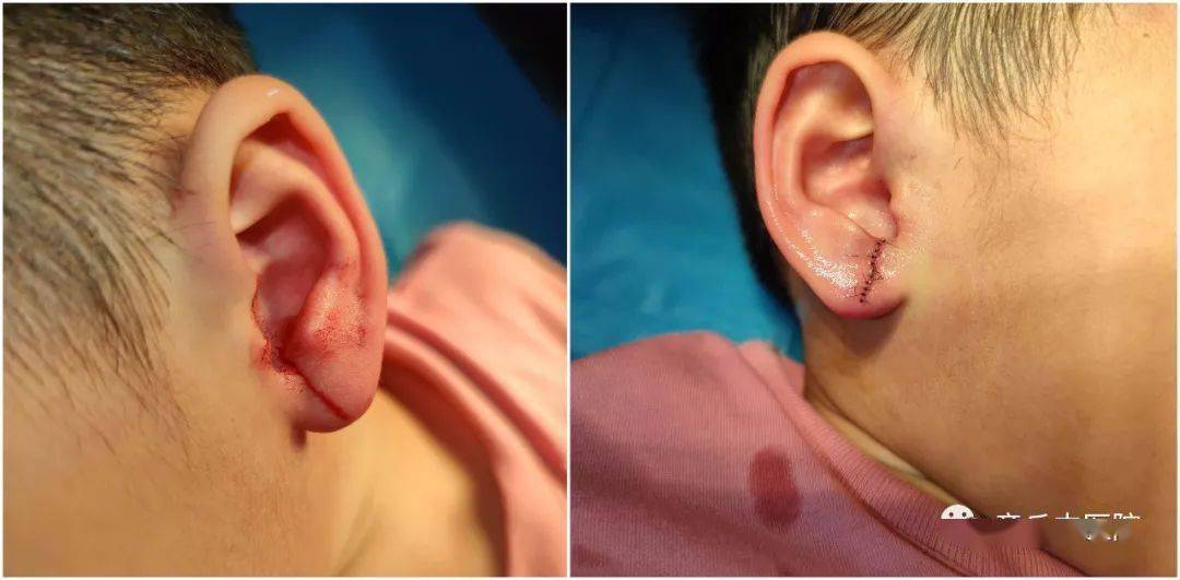 近日,玺玺小朋友在家中玩耍时,不慎将耳朵磕穿,家长赶紧带孩子来到