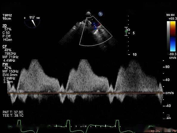 肺静脉频谱图解析图片
