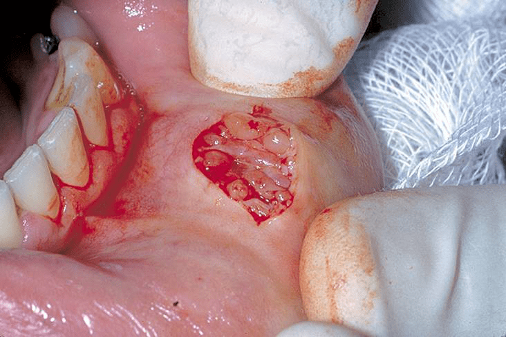 别害怕带你了解小唇腺活检干燥综合征诊断的重要检查