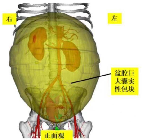 手术|女子肚子突然增大！以为吃胖了，结果竟是长了……医生重要提醒