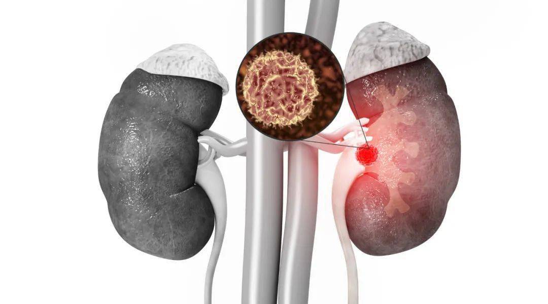 肾脏|一颗小石头毁掉一个肾!疯狂的石头怎么破?
