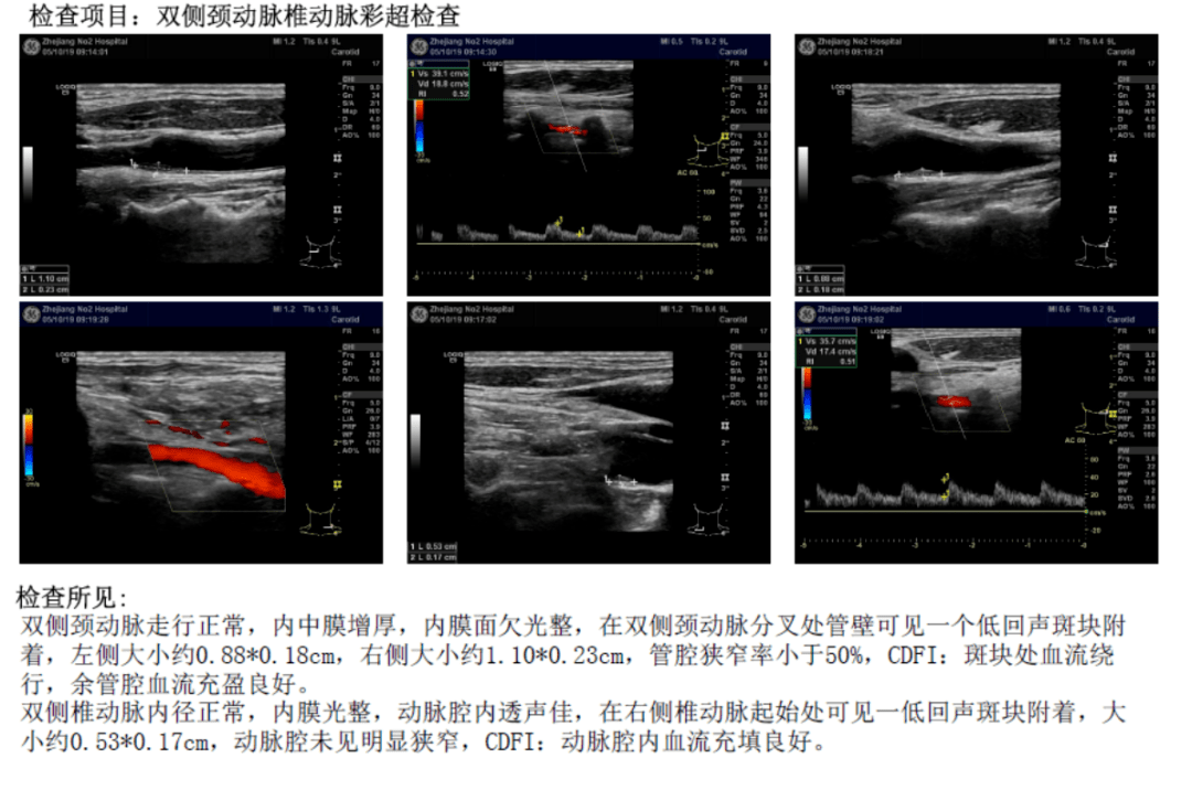 颈动脉超声:影像学检查:超声心动图检查示,心肌厚度正常,活动欠协调