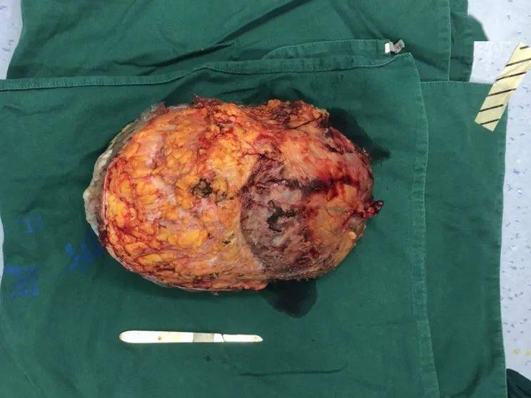 乳腺导管瘤 真人图片