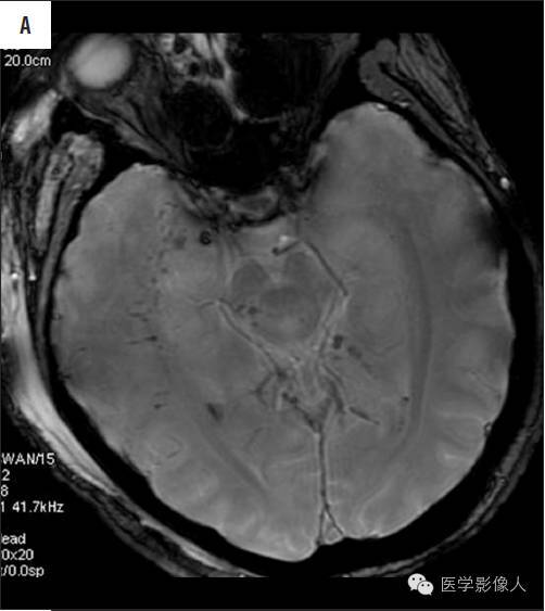 黄素环|脑内T2WI上低信号病变大致分为8大类【总结】